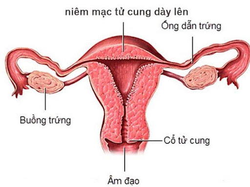 Có nhiều nguyên nhân dẫn đến hiện tượng nội mạc tử cung dày